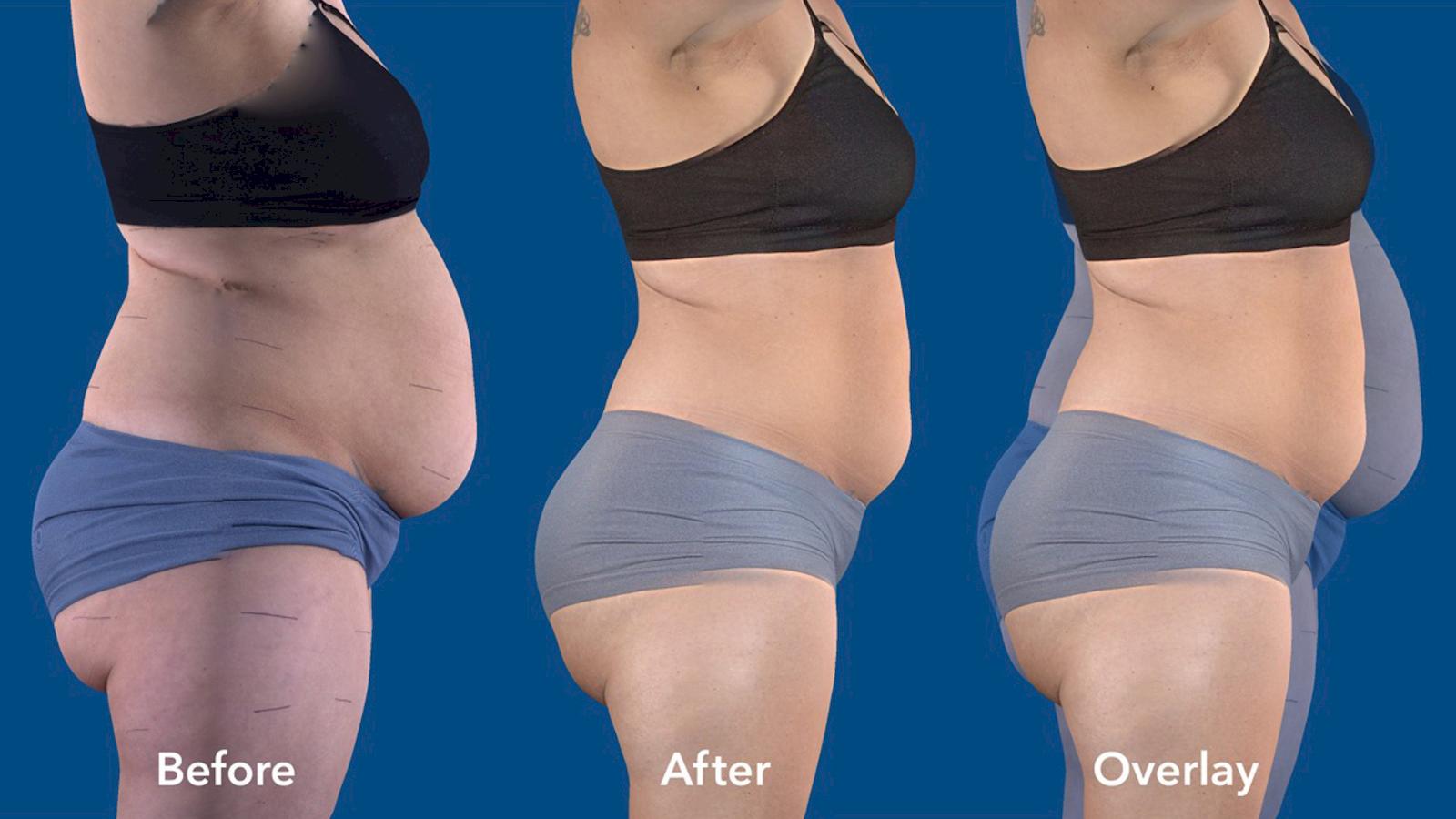 Hannah Before and After Results